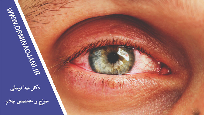 عفونت‌های مسری چشم: علل، علائم و درمان