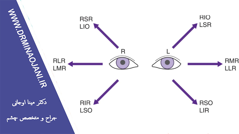 بازگشت انحراف چشم بعد از جراحی