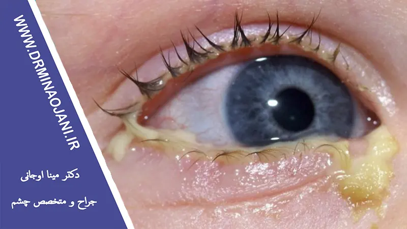 چگونه از بروز عفونت‌های چشمی جلوگیری کنیم؟