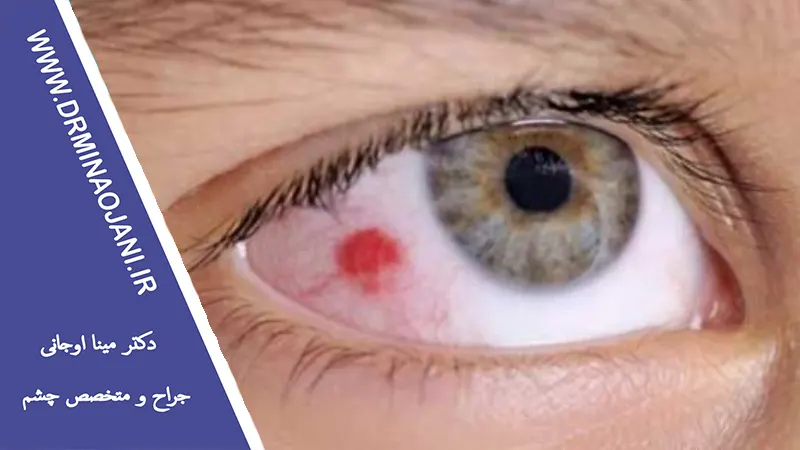 درمان آسیب‌های چشمی ناشی از تصادفات