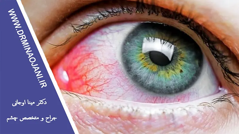 عوامل خطر ابتلا به بیماری شبکیه چش