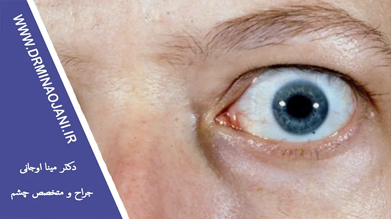 چگونه بیماری‌های تیروئید می‌توانند بر روی چشم‌ها تأثیر بگذارند؟