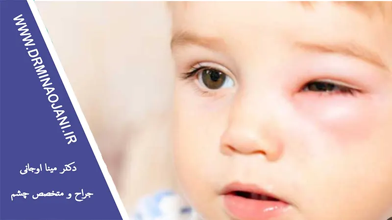 نشانه‌های رایج بیماری‌های چشمی در کودکان